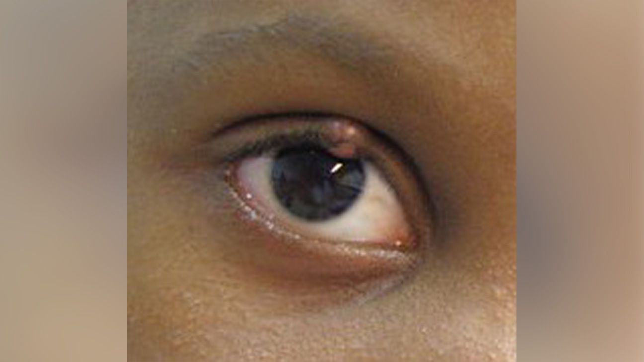 Chalazion