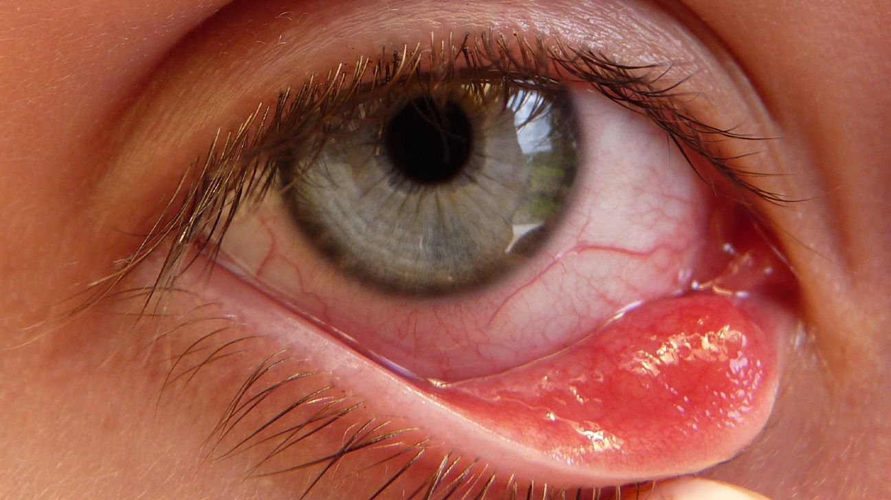 Chalazion