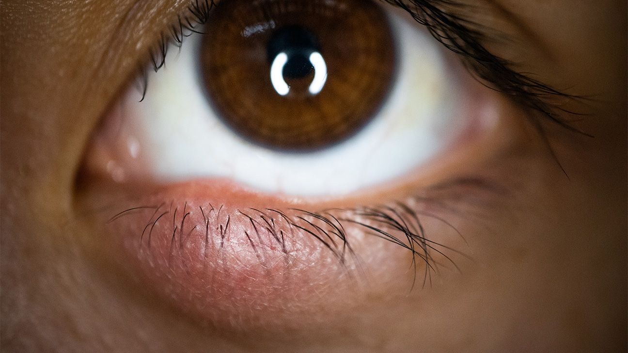 Stye