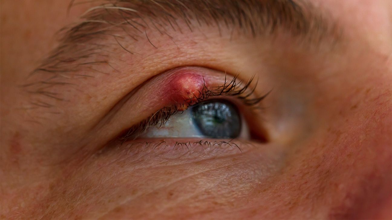 Stye