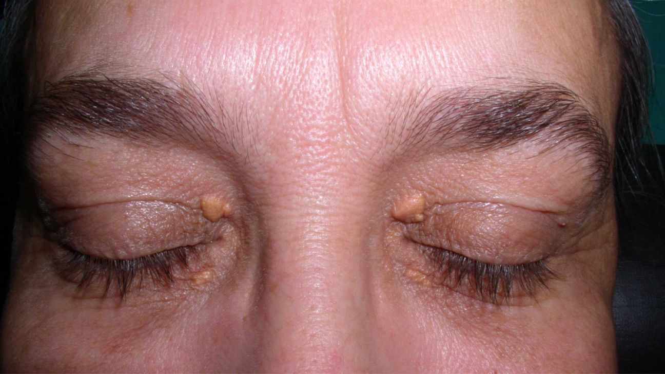 Xanthelasma