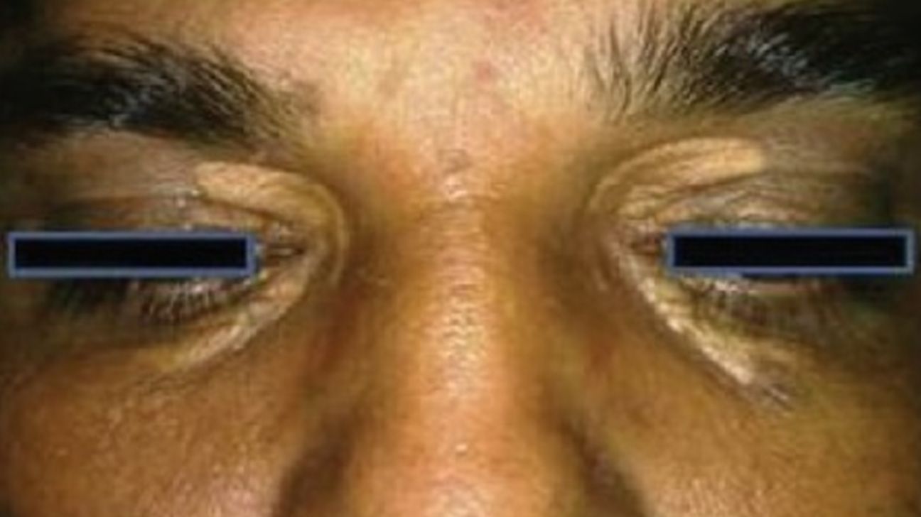 Xanthelasma