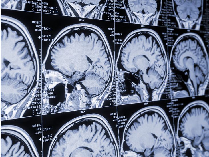 What to know about Gerstmann-straussler-scheinker syndrome