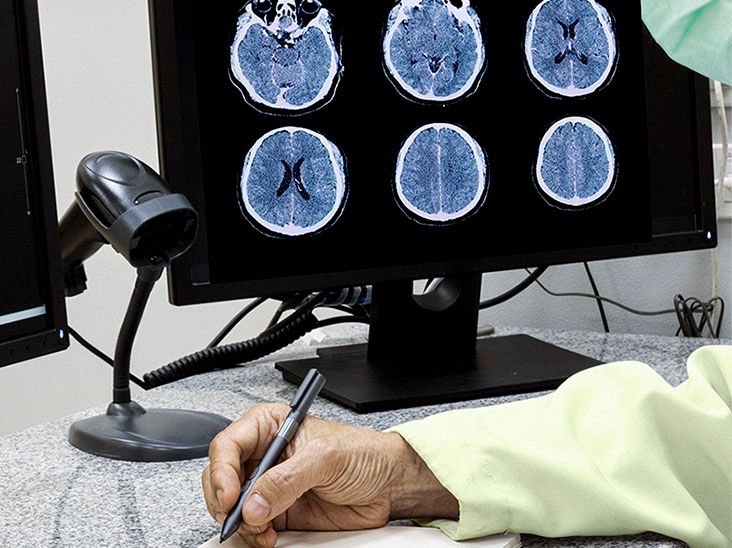 What to know about cerebellar ataxia