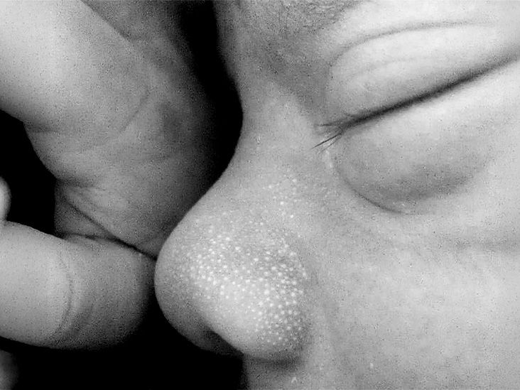 Milia in newborns and babies