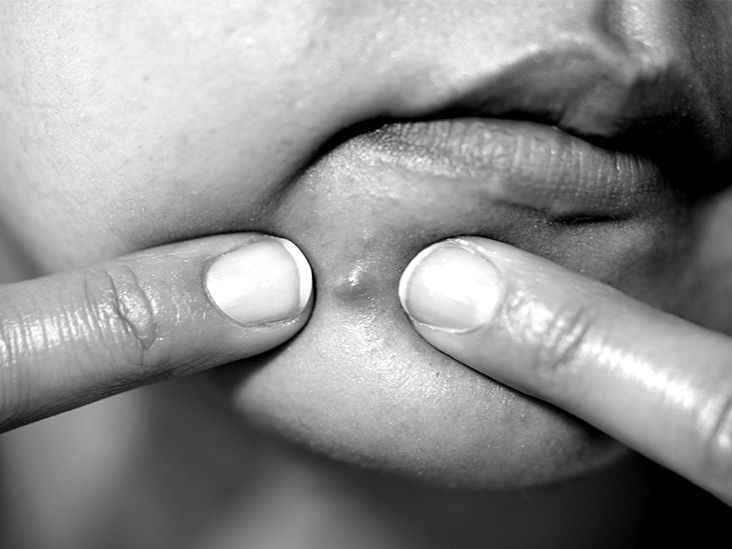 Pimples on the chin: What it means and how to get rid of them