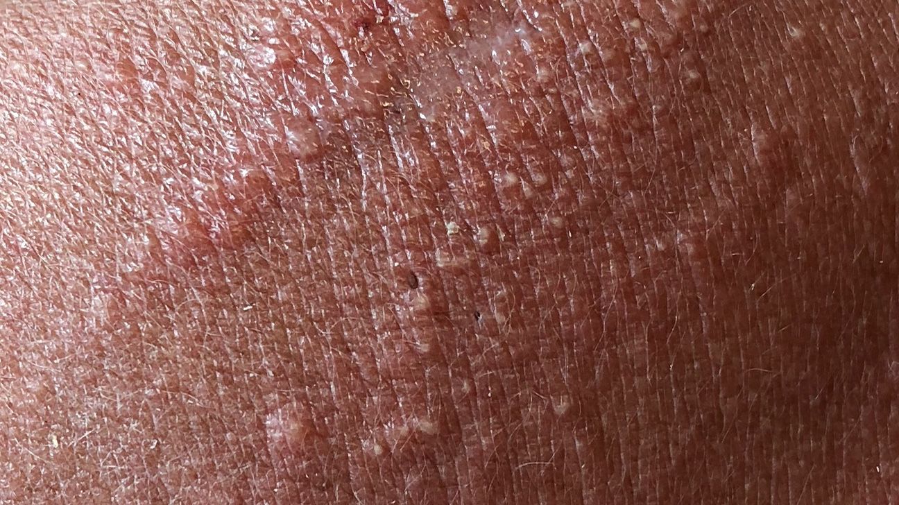 https://media.post.rvohealth.io/wp-content/uploads/sites/3/2025/05/Contact-Irritant-Dermatitis-1296x728-slide02.jpg