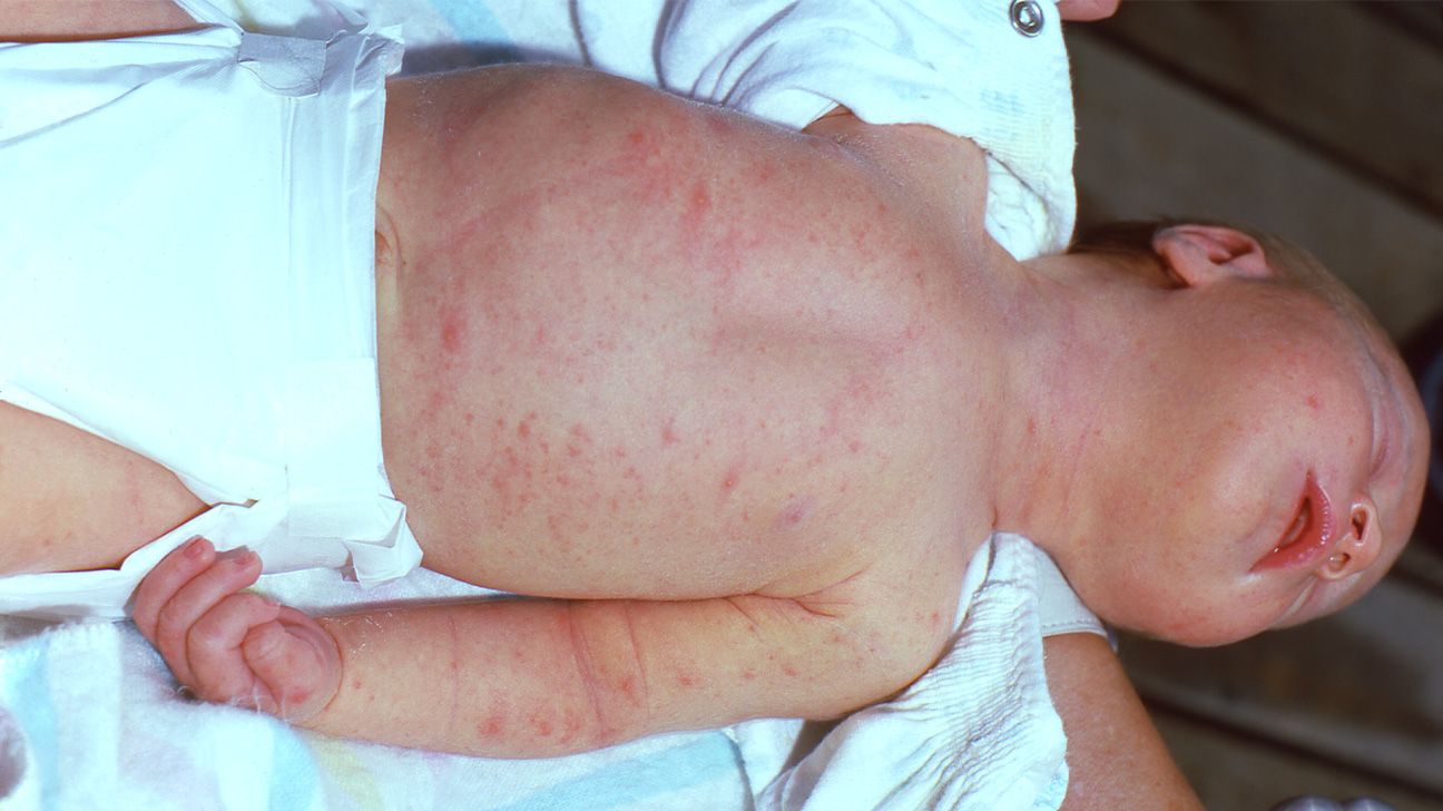 14 Common Rashes in Babies and Kids, image size:1296x728