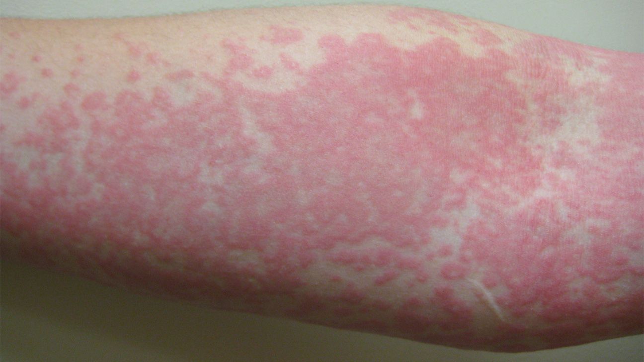 5 Skin Disorders You Might Mistake for Hives | HowStuffWorks, image size:1296x728