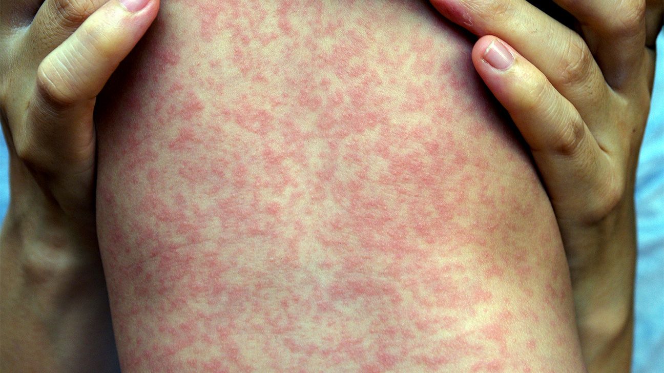 Chickenpox vs. measles: Symptoms, pictures, treatments