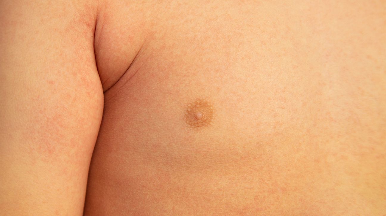 Heat Rash In Toddlers Chest