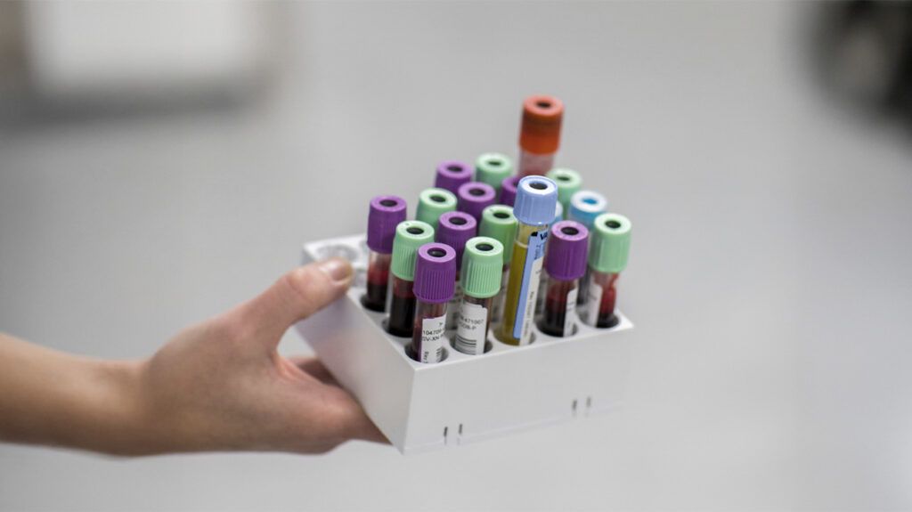A person holding a tray full of test tubes of blood to be sent off for Alzheimer's diagnosis