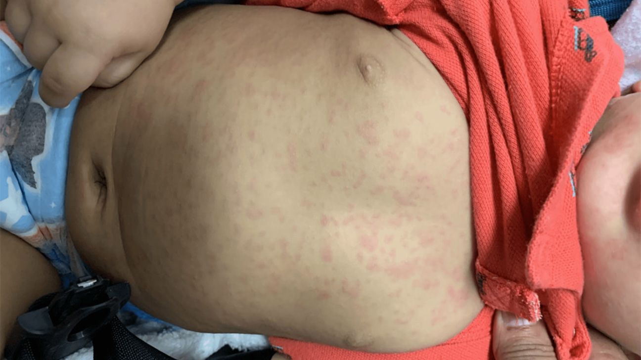 Dermatologists provide tips on how to get rid of heat rash fast, image size:1296x728