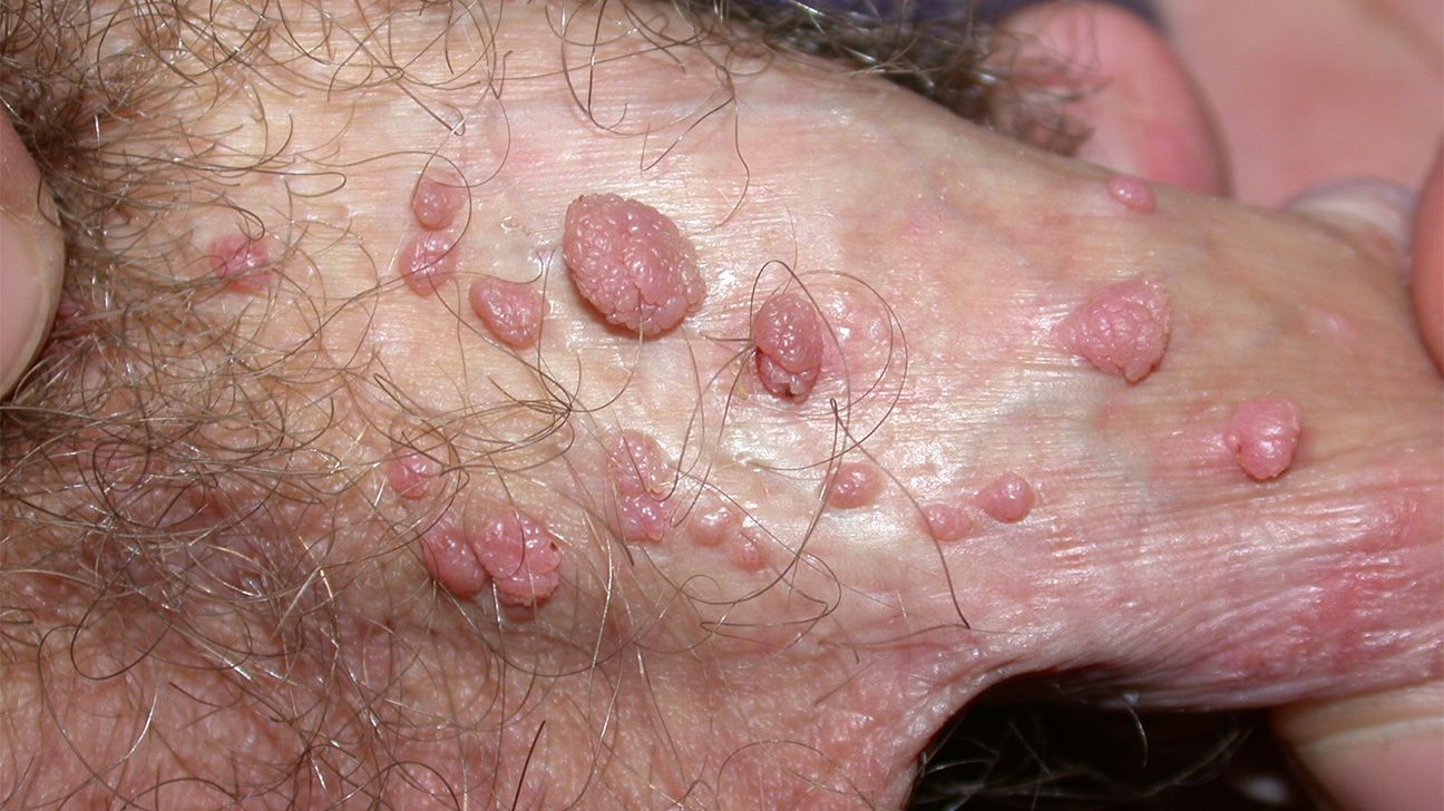 White spots on testicles: Causes, treatment, and more, image size:1296x728