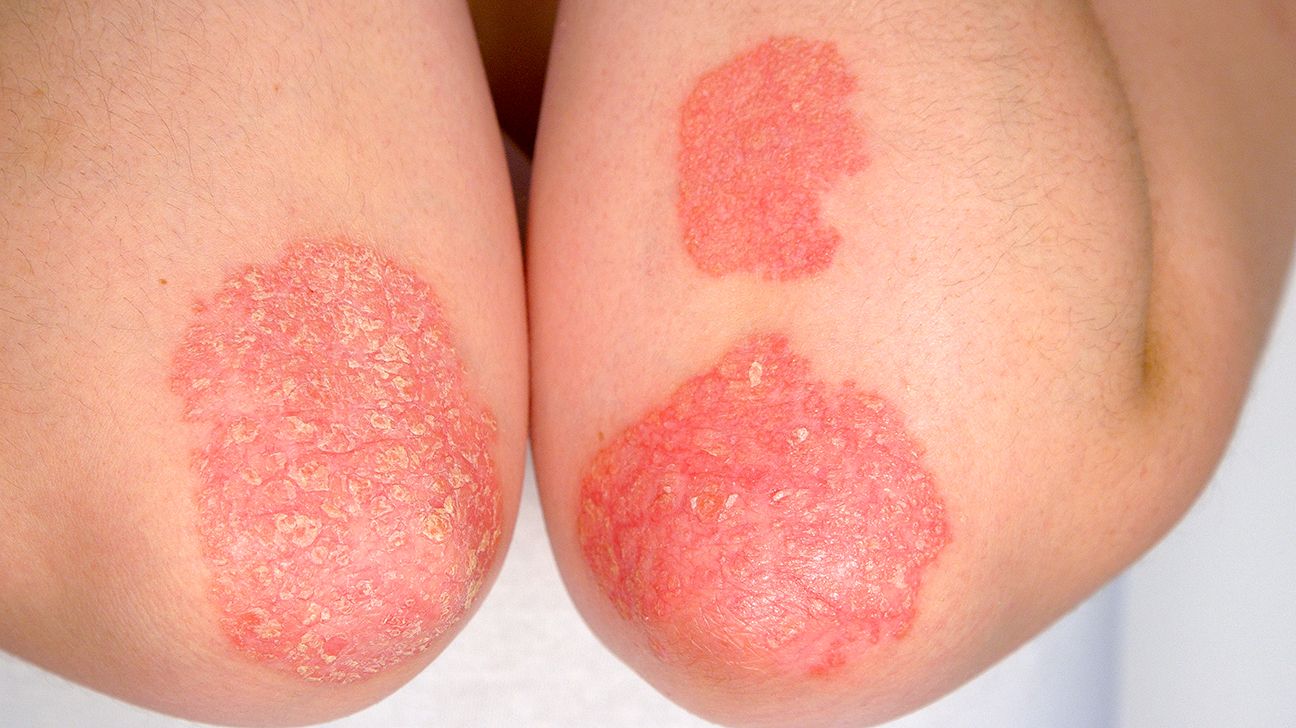 Psoriasis Vulgaris