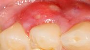 Abscessed Front Tooth