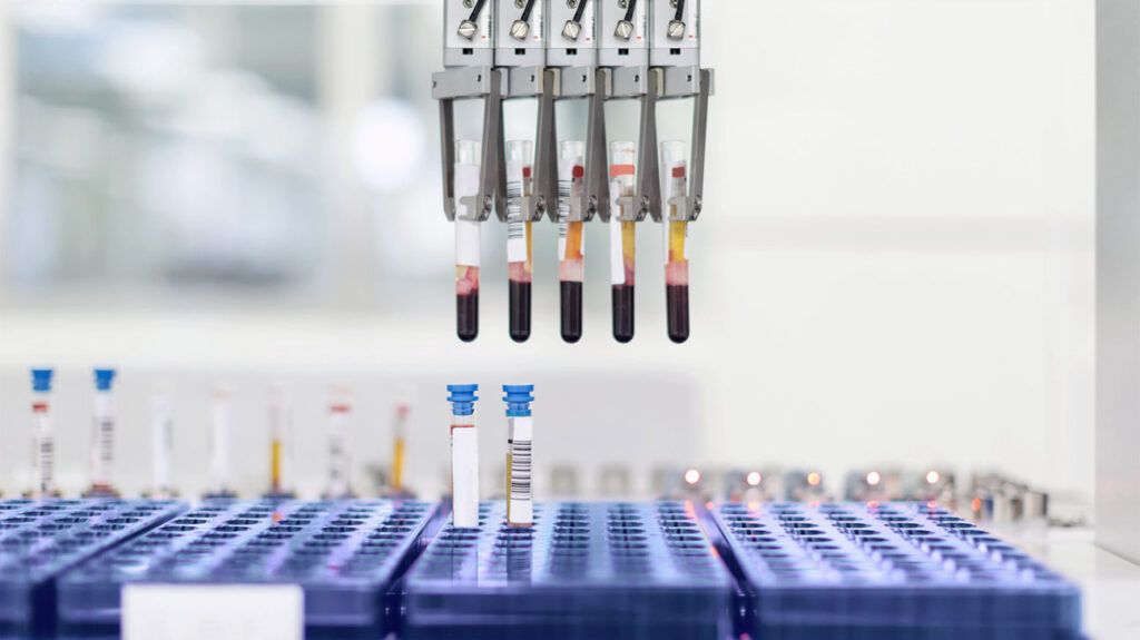 Blood Test for Insulin Resistance May Help Predict Early Alzheimer's Cognitive Decline