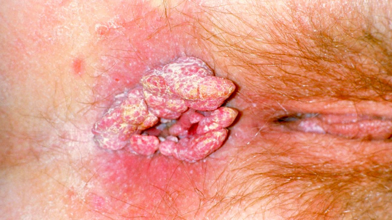 What do genital warts look like? Symptoms and treatments, image size:1296x728
