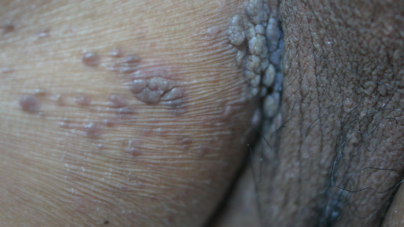 What do genital warts look like? Symptoms and treatments, image size:1296x728
