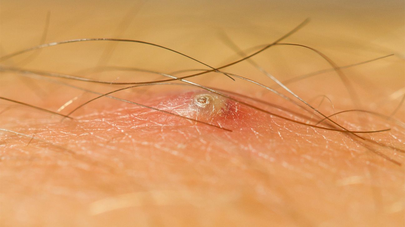 Ingrown hair or herpes: What is the difference?, image size:1296x728