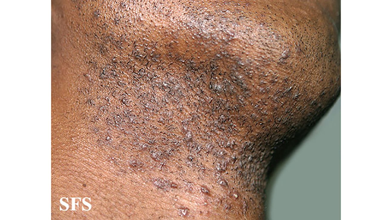 Ingrown hair or herpes: What is the difference?, image size:1296x728