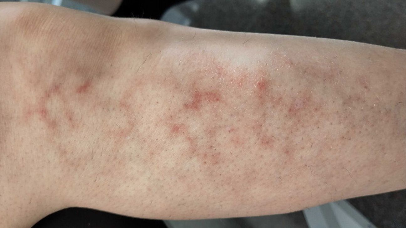 Heat Rash vs. Eczema: What's the Difference?, image size:1296x728