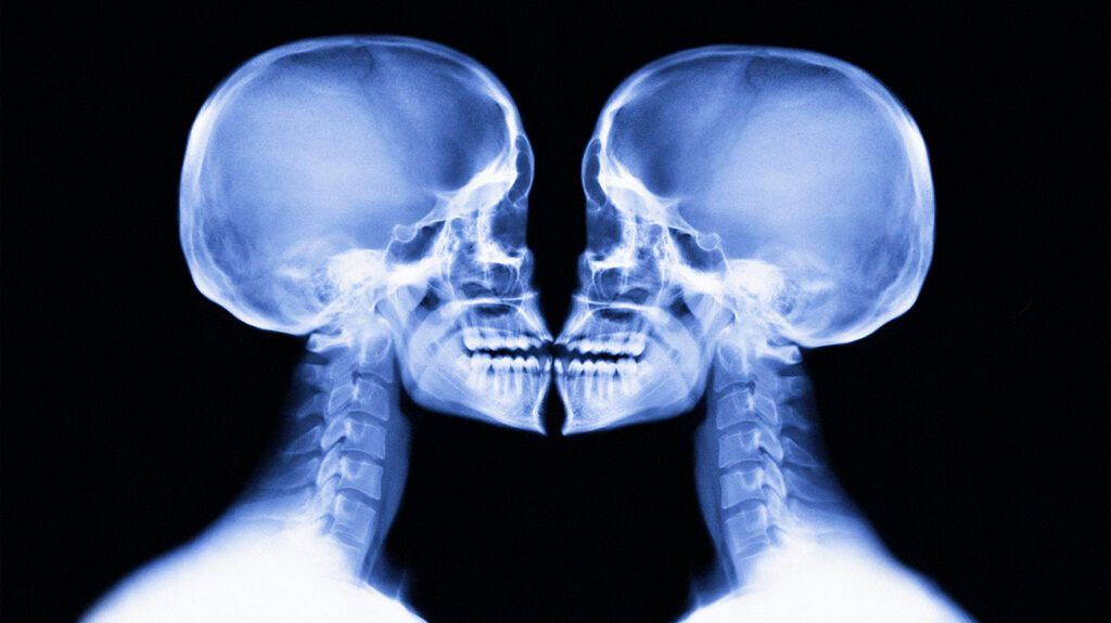 Two xray skulls facing each other 1