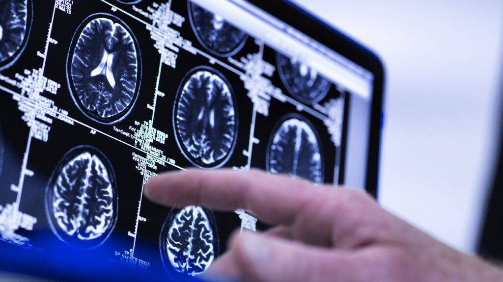 Single Brain Scan Could Predict Risk of Age-Related Conditions Like Dementia