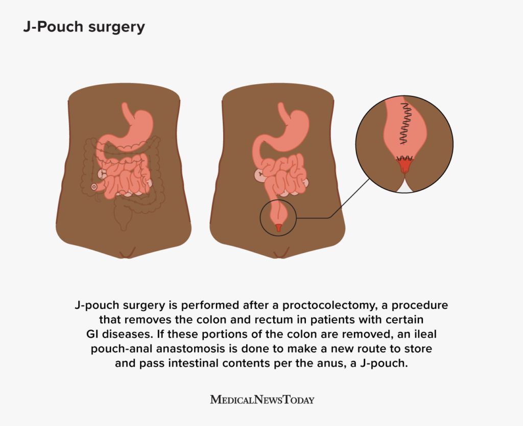 Infographic showing the stages of j-pouch surgery
