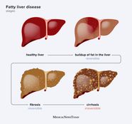 Cirrhosis Skin Symptoms Belly Images In Females Cirrhosis Skin Symptoms Belly Images In Females