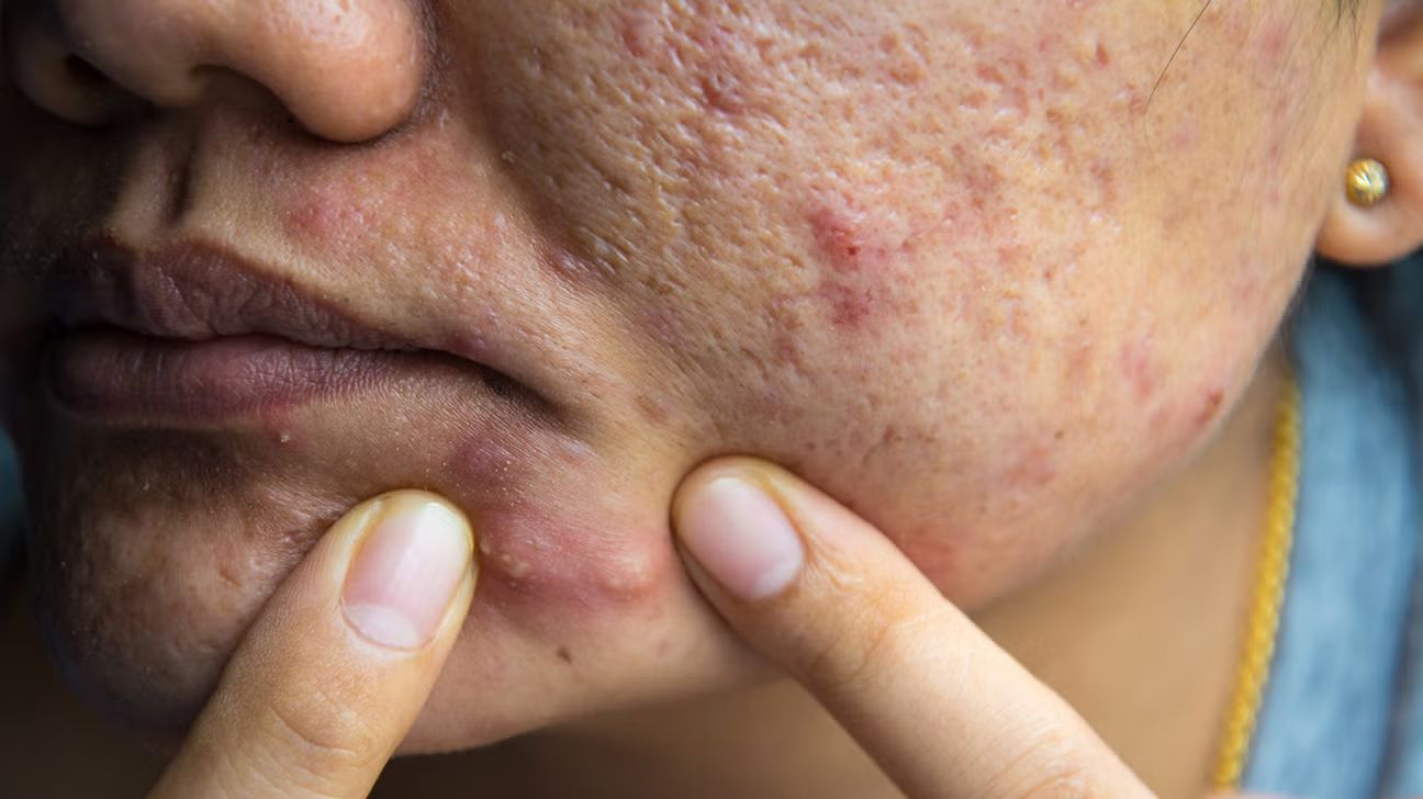 12 Ways to Get Rid of Piercing Bumps, According to Pros, image size:1296x728