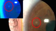 White Spot On Conjunctiva