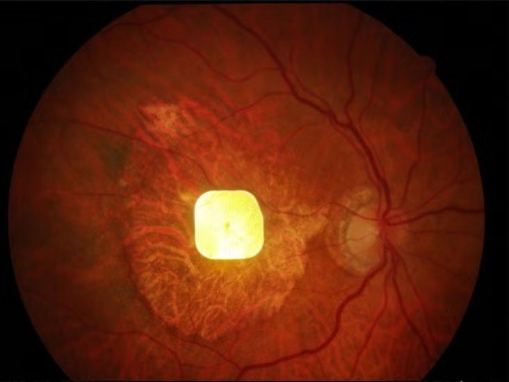 New retinal implant may restore central vision in people with advanced AMD