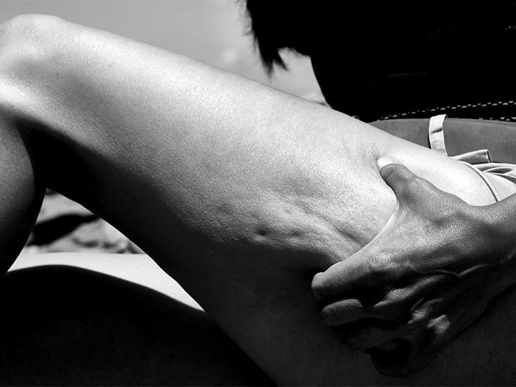 Cellulite: Causes and what can treat it