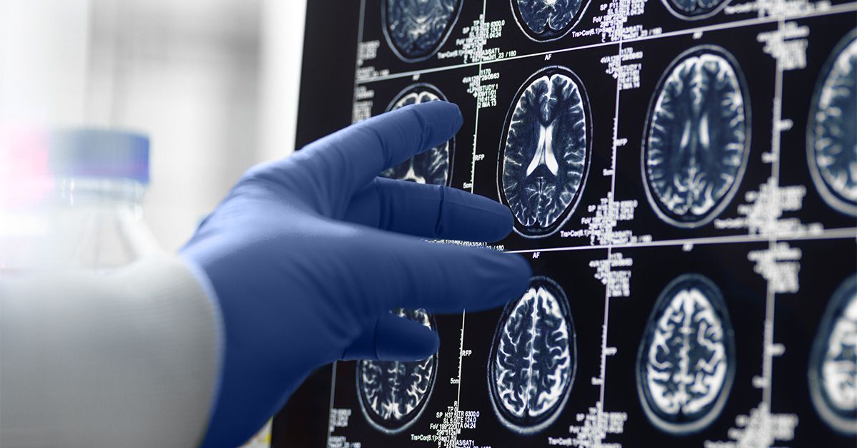 Scientists spot brain changes that may help predict stages of dementia