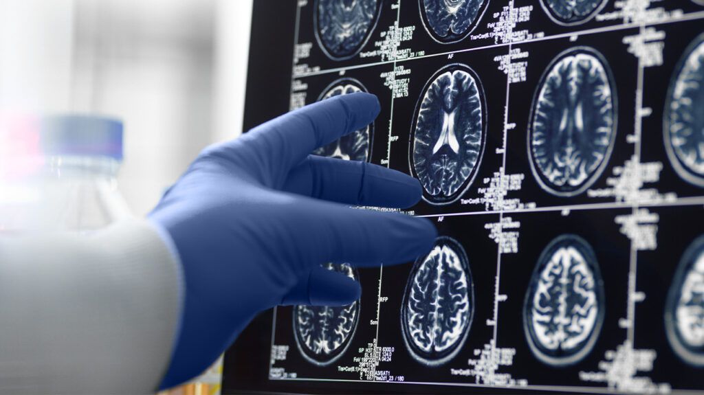 A doctor examines brain scans to spot Alzheimer's disease with a gloved hand