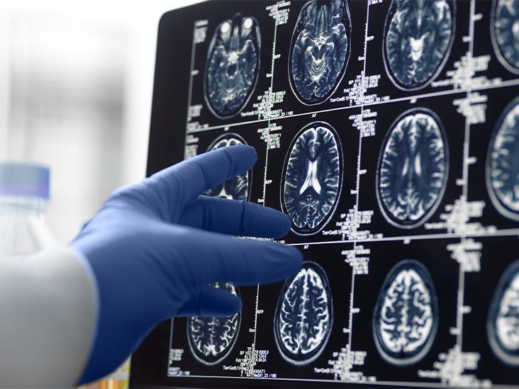 Scientists spot brain changes that may help predict stages of dementia