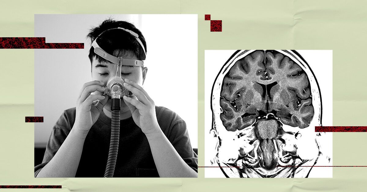 Could treating obstructive sleep apnea lower stroke or dementia risk?