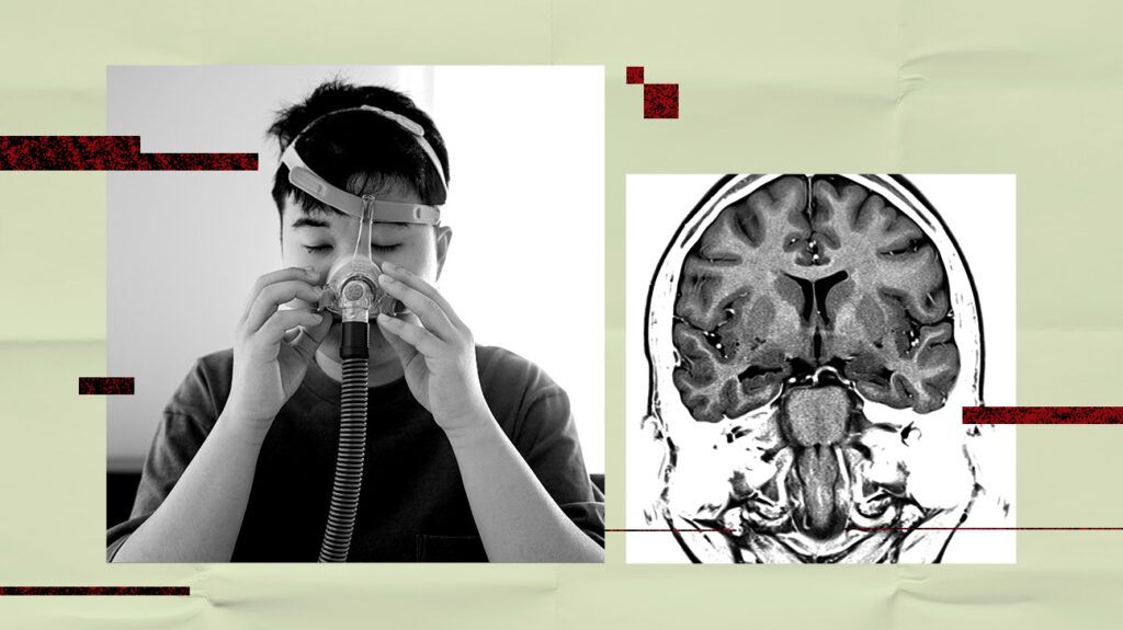 수면 무호흡증 치료를 위해 CPAP 마스크를 착용한 사람과 뇌 스캔 사진 콜라주
