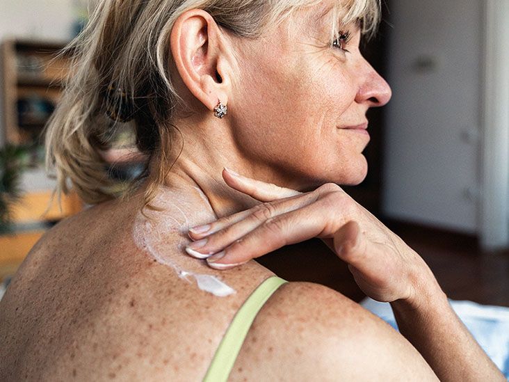 Can perimenopause make eczema worse?