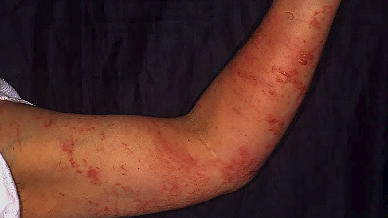 Esuma Rash Poison Sumac Rash Pictures And Treatment 1296x728