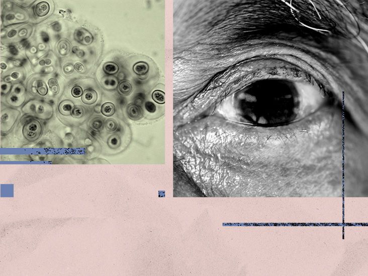 Could this common bacteria in the eye be driving Alzheimer's disease?
