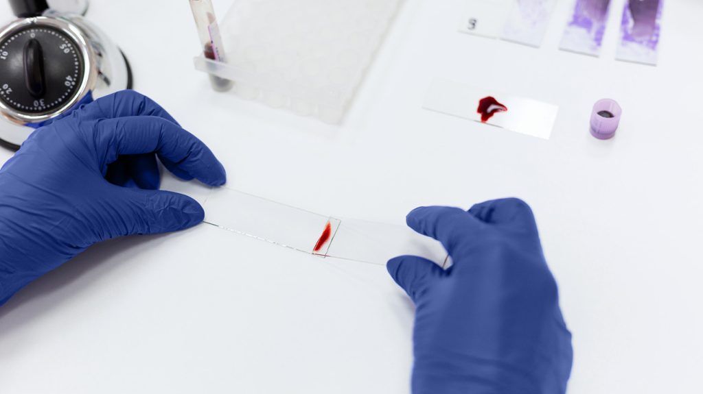 A lab worker tests a sample of blood to predict dementia risk