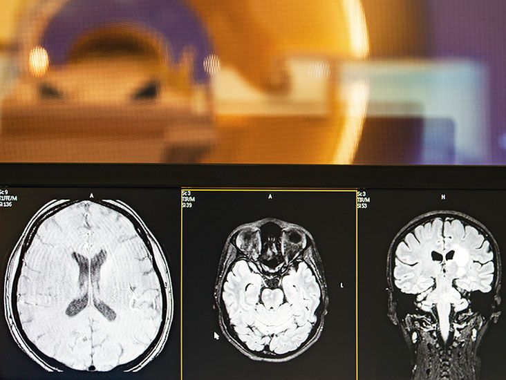 Could the gut be driving age-related memory loss?