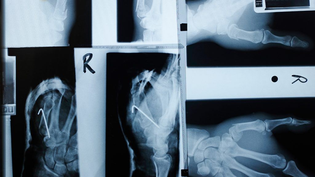 can semaglutide cause bone loss Type 2 diabetes: Semaglutide may help protect bone health