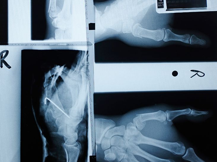 GLP-1s may aid bone health as well as weight loss in type 2 diabetes