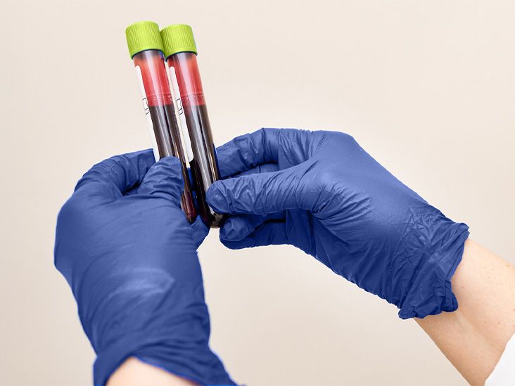 Alzheimer’s blood test around ages 53-69 may help detect early cognitive decline