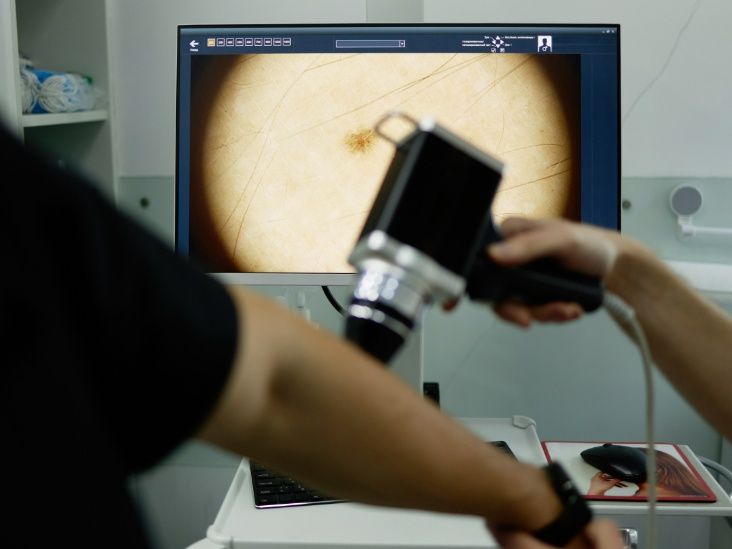 Skin cancer checks: What AI can help catch — and how to check yourself at home