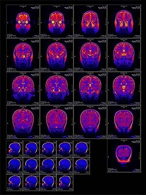 Brain Tumors May Present as Depressive Symptoms