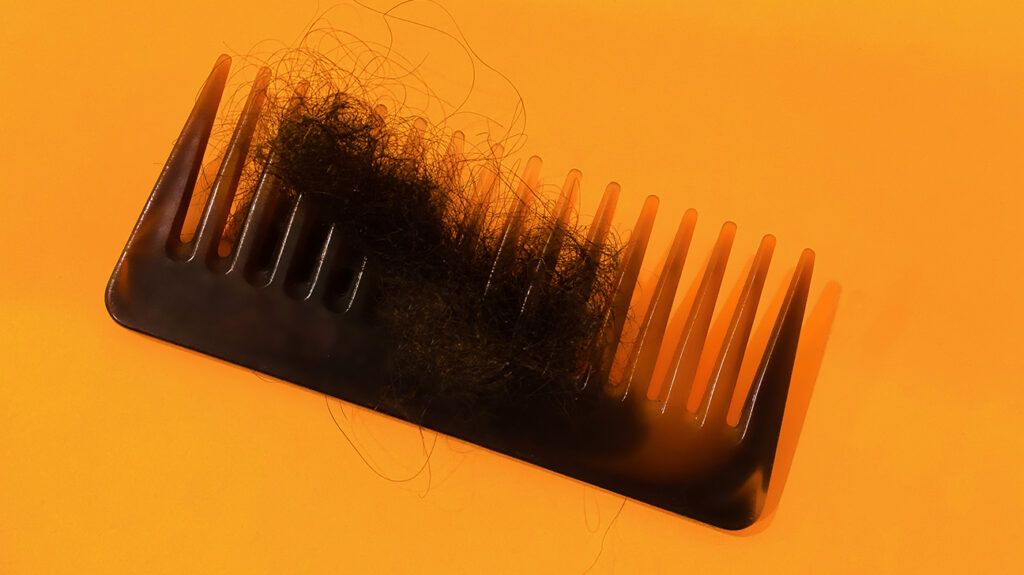 Comb filled with hair loss due to stress